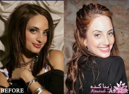 جراحی بینی - جراحی زیبایی